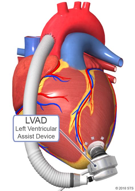 lv assist devices|left ventricular assist device indications.